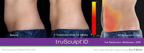 trusculpt id reviews